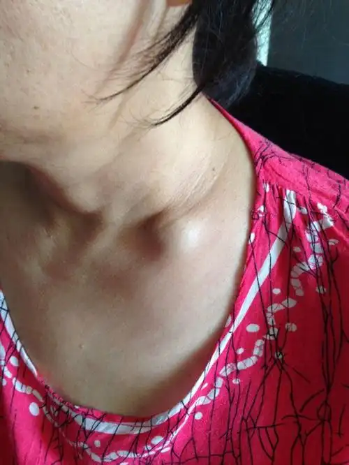 青岛淋巴结肿大医院_青岛治疗淋巴结肿大哪家医院好_青岛治疗淋巴结