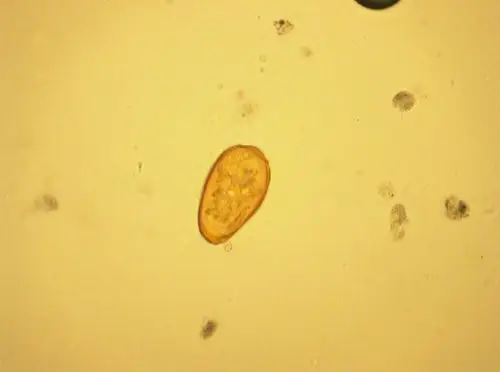 【资源】肺泡灌洗液中查到肺吸虫卵一例