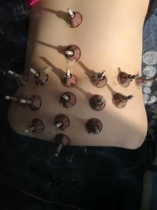 艾灸整个下腹部,每天一次,一次三遍.