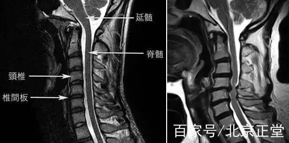 脊髓型颈椎病的治疗注意这两点!