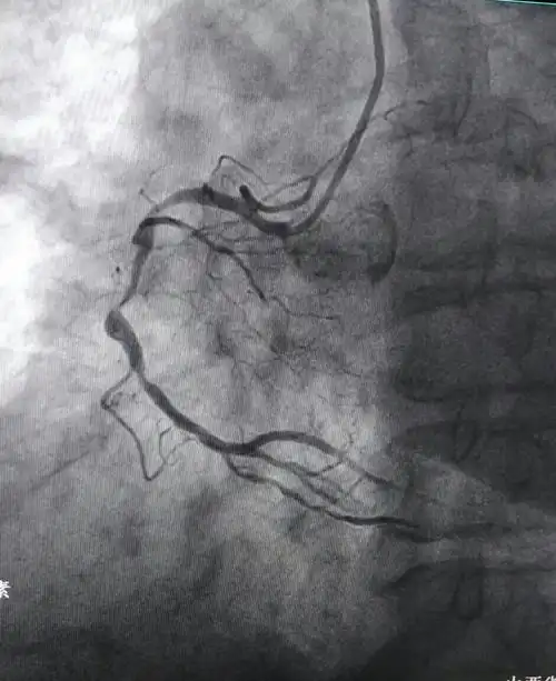 医院】北京阜外医院心血管病专家再次来我院开展冠脉造影及支架置入术