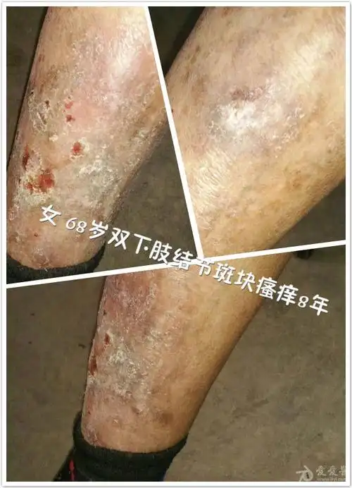 慢性湿疹苔藓样变一例