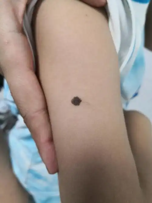 黑色素痣##胎记##解决皮肤问题专注皮肤美容