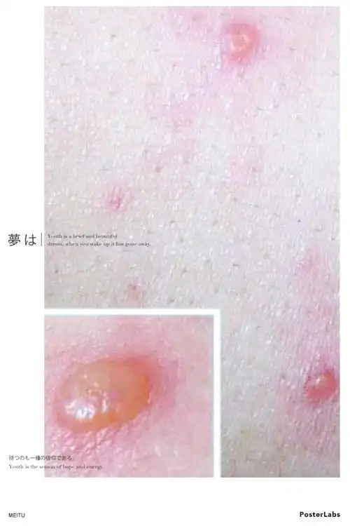 乐亭三幼温馨小贴士一一水痘的预防!