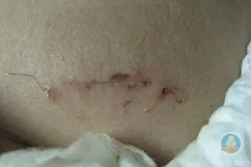 分娩方法,现在为大家介绍自然生产和剖腹生产,以及注意事项.