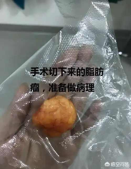 脂肪瘤有什么好的处理方法么