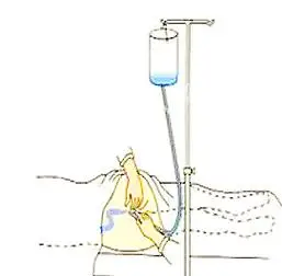 盆腔炎进行直肠给药的治疗优势有哪些?