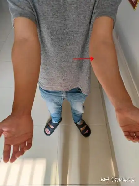 小时候骨折没复位好现在成了肘外翻畸形手术矫形后即刻正常