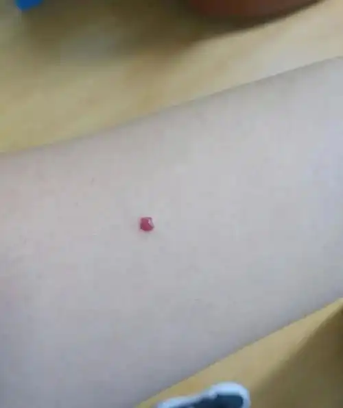 血痣不用怕咱老百姓有验方