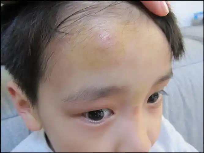 aric受伤的额头,肿了好大一个包.