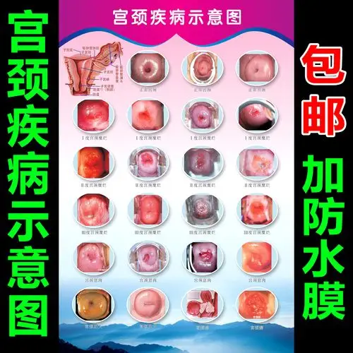 宫颈疾病糜烂示意图女性生殖器解剖图 医院宣传海报挂图 妇科知识