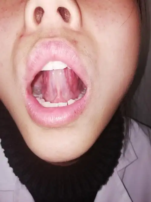 舌下络脉瘀滞20