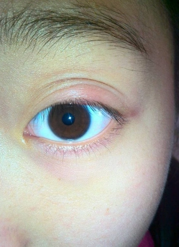 甲亢突眼医院_治疗甲亢突眼哪家医院好_治疗甲亢突眼权威的医院/排行