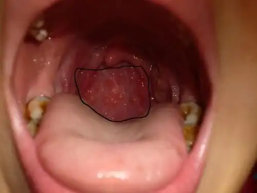 喉咙里起泡,还一个劲的咳嗽