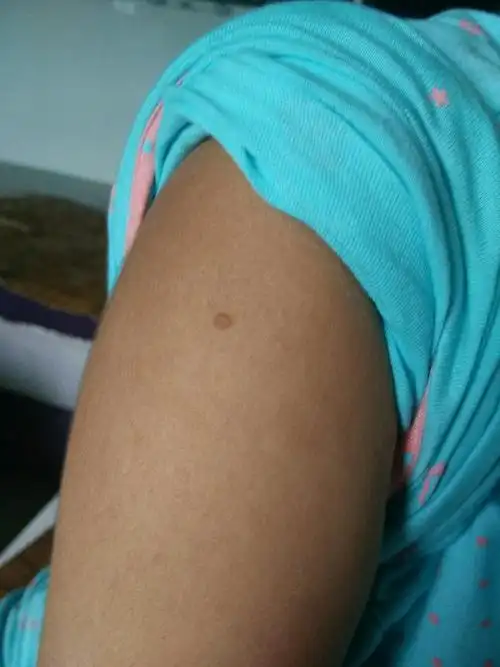 有长扁平疣的么,怎么治疗