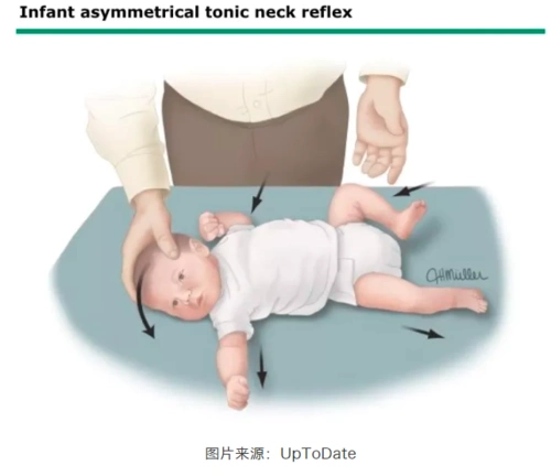 踏步反射使婴儿保持垂直体位,脚与平坦表面接触,可观察到踏步反射,即