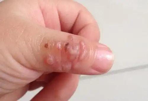 你的孩子爱"嘬手指"吗?