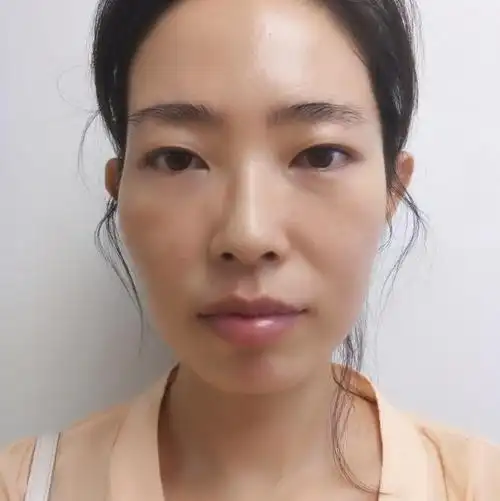 面部松弛与面部凹陷的区别很大吗?抗衰该先提升还是填充?