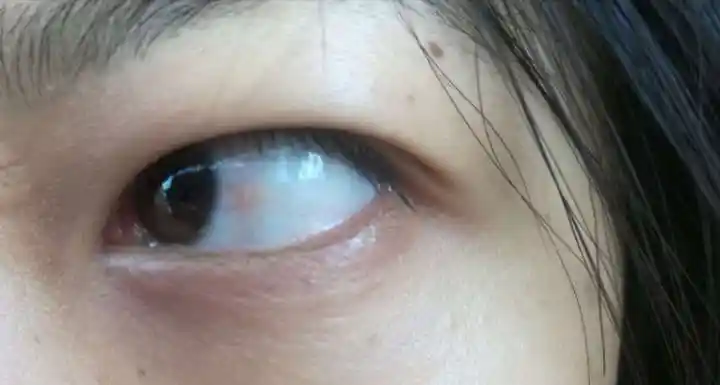 非常常见的睑裂斑