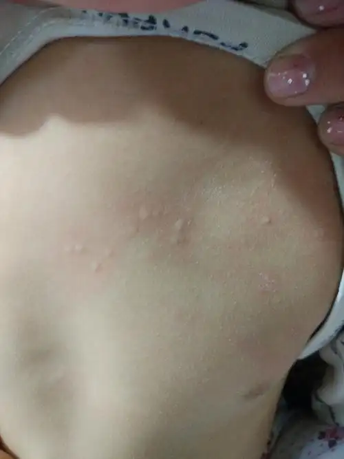 宝宝身上突然起了一些小包,请问一下这是怎么回事?