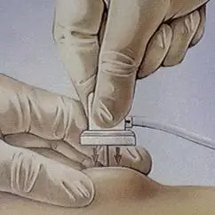 聚焦临床输液港一种更体贴的输液方式反复使用可保留510年