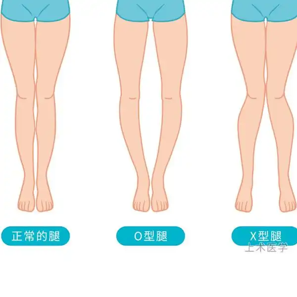 关于孩子o型腿,x型腿的正确认识