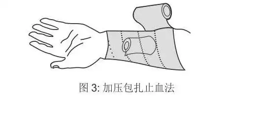 2,指压止血法直接压迫伤口,适用于静脉和毛细血管出血.