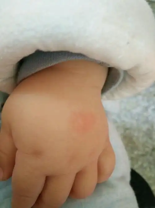 宝宝是被咬了,还是手足口