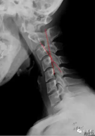 颈椎病解剖,经典影像改变,看这一篇就够了!