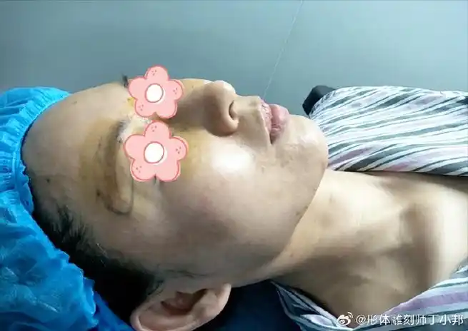 奥美定取出##注射物取出##丁小邦注射物取出