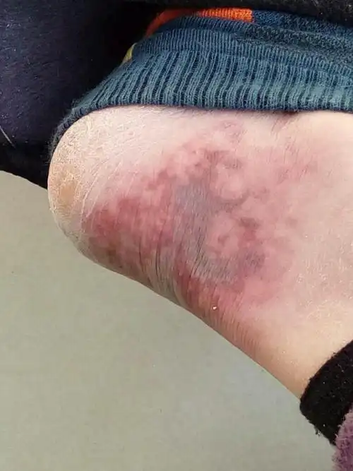 脚后跟冻疮发紫