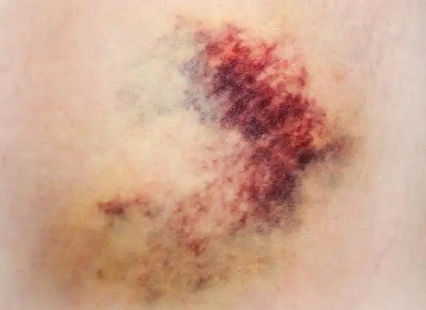 身上无缘无故有淤青可大可小若伴有两种情况或暗示大问题