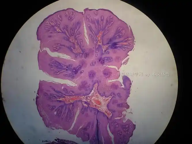 悬雍垂乳头状瘤?