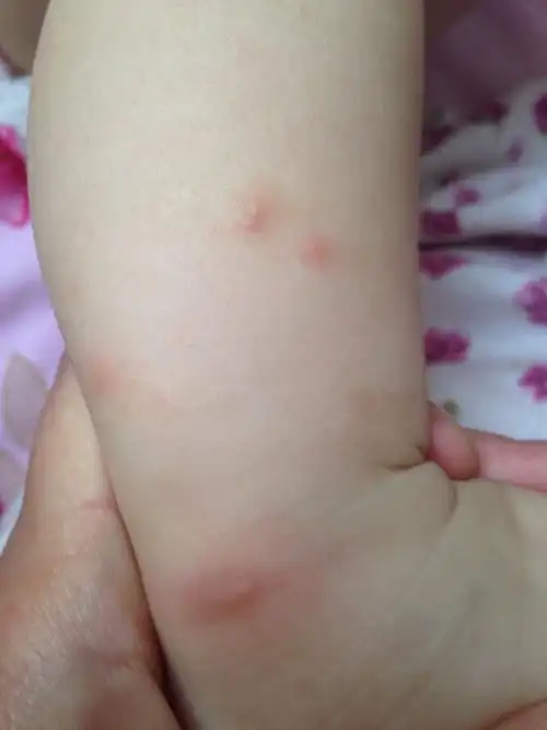 我家宝宝9个月了,前几天发烧过后身上就起了好多水痘子,该怎么治疗?