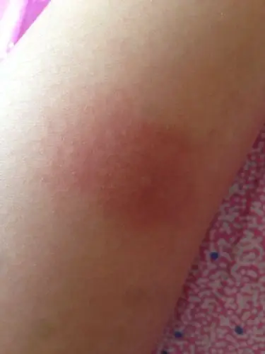 不知道是不是蚊子!特别痒,肿了红了一大片!求解答!