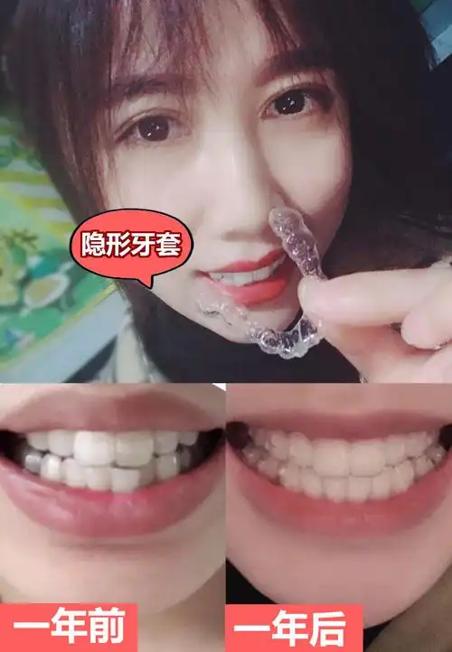 隐形矫正|戴了一年牙套,朋友说我仿佛变了一个人