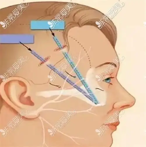 做美国强生鱼骨线雕亲身经历分享 重点说说我的埋线心得