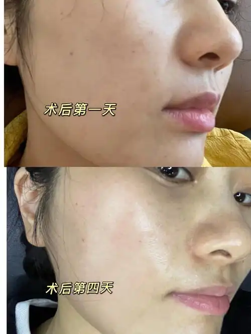 今天是我做完光子嫩肤第5天