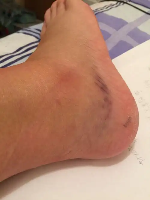 崴脚8天了 ,脚踝内侧很肿肿成一个疙瘩的感觉 外侧也肿然后淤血.