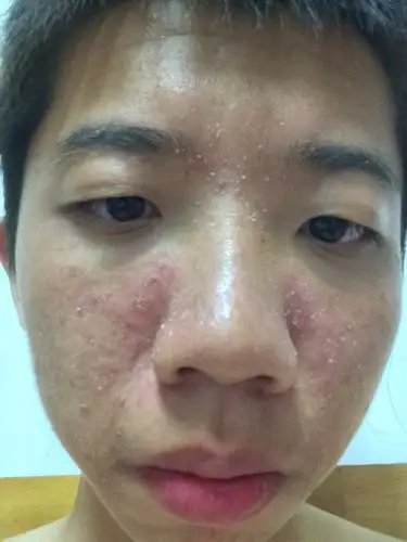 我的脸上前两天开始变成这样,可能是昨天今天有抠掉