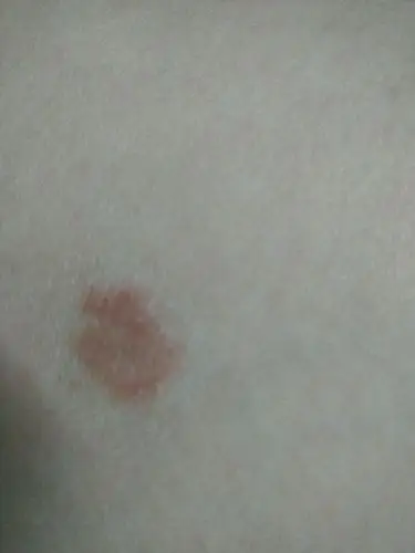 大腿上长了一个硬币大小红色的癣,不是很痒!担心会越来越大!
