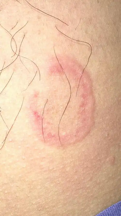 大腿根环形红斑请指导 - 皮肤及性传播疾病讨论版 - 爱爱医医学论坛