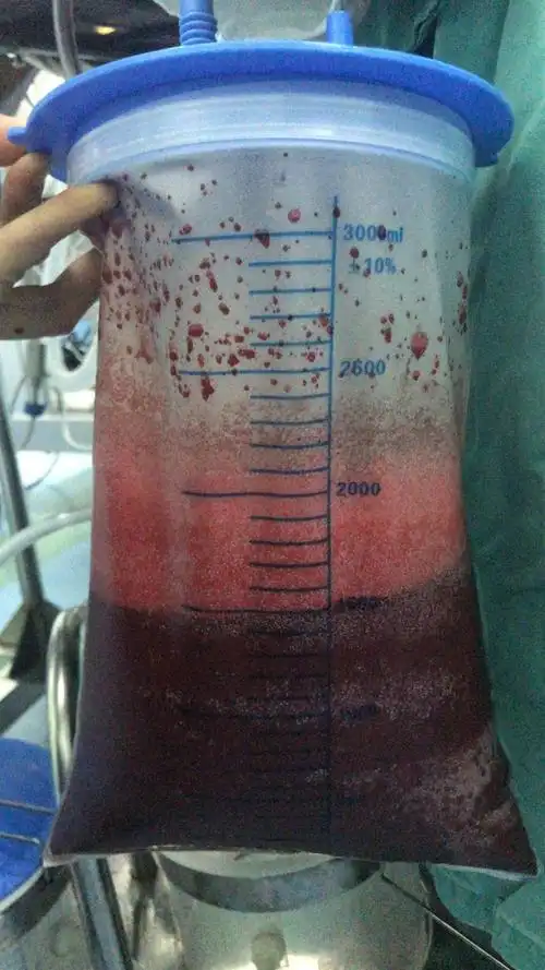 术中清出血液约有1300ml