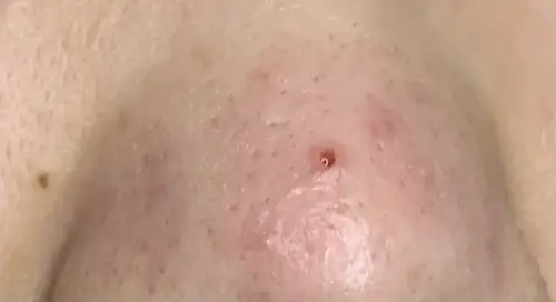 家人们我刚刚挤出来一个巨大的黑头会不会有事(有图慎入)