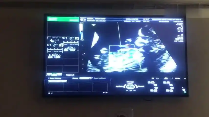 试管婴儿第13周b超产检一切正常,可以看到宝宝在肚子里动来动去-母婴