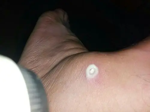 脚怀上长个脓包,用针扎破了用酒精消毒,两三天了,你们知道这是什么吗?