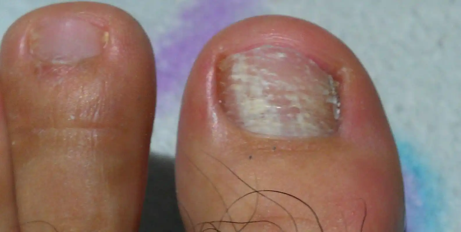 指甲上的白点,竖纹,月牙分别代表了什么?月牙多的人更健康吗?