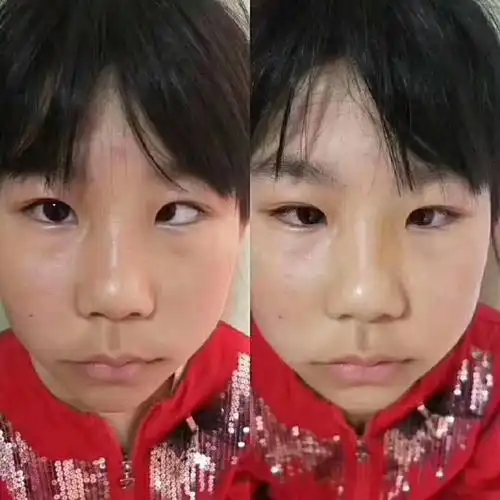 近视斜视调理前后
