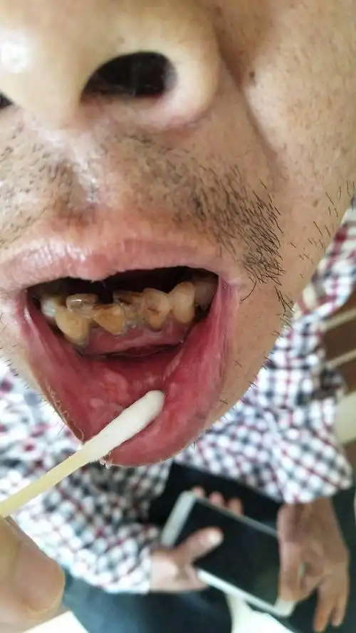 口腔粘膜白色大斑块