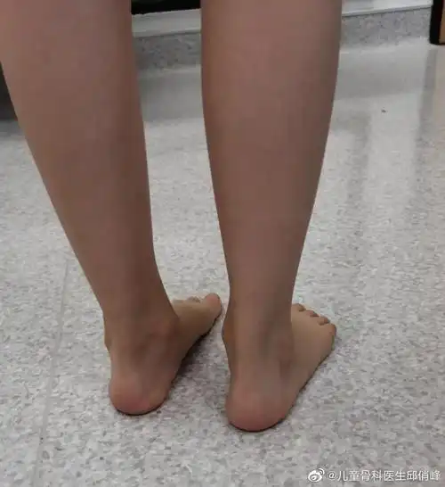 6岁孩子,稍微有点膝外翻,宝妈却仍不满意,希望更好一些